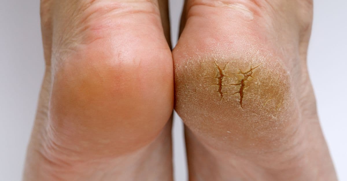 Callus
